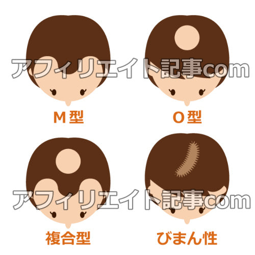 イラスト図解素材「女性の薄毛の種類（ブラウン髪）」